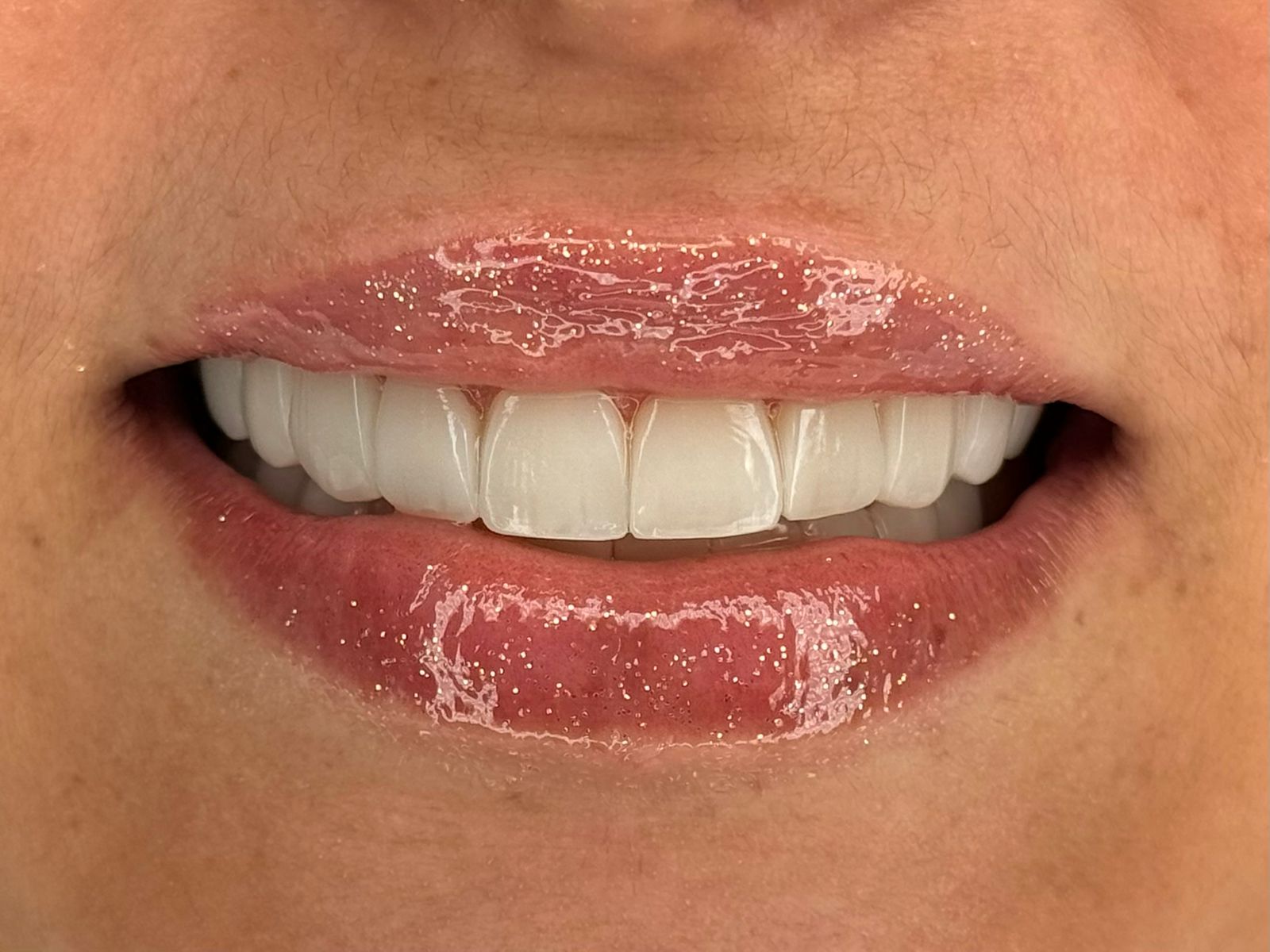 Procedimento Dra. Mariana — lentes e brilho labial