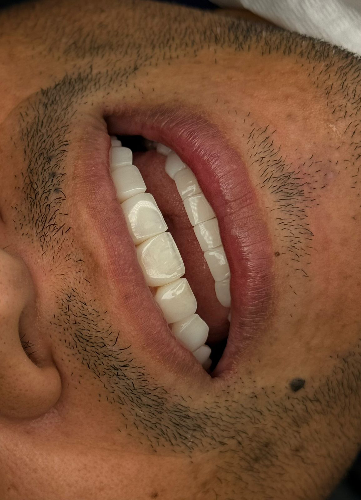 Procedimento Dra. Mariana — sorriso masculino